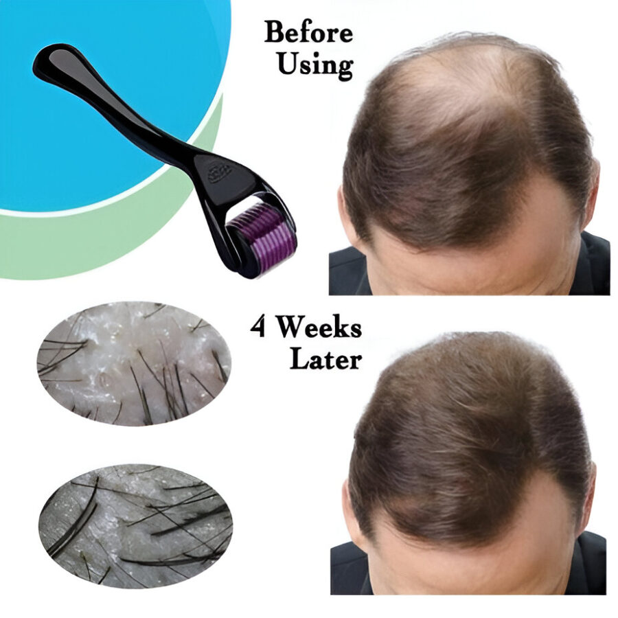Derma Roller Hair Therapy Micro-Needle | Derma Roller for Hair re-growth & Skin For Male And Female (0.5mm)